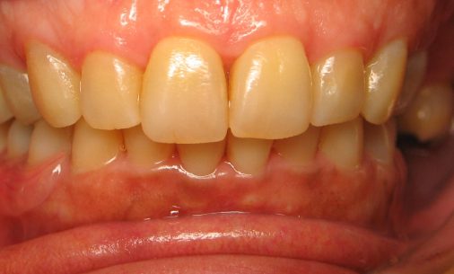 after1 Abari Orthodontics and Oral Surgery - before & after
