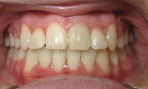 after11 Abari Orthodontics and Oral Surgery - before & after