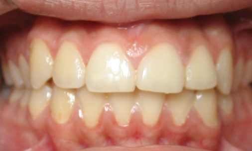 after5 Abari Orthodontics and Oral Surgery - before & after