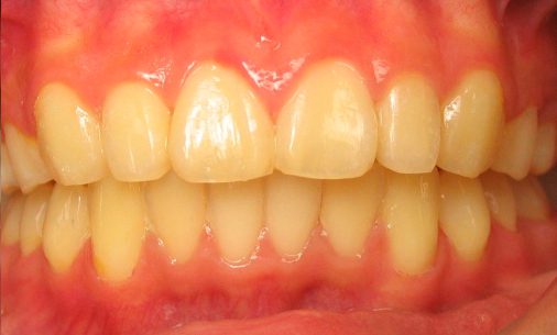 after8 Abari Orthodontics and Oral Surgery - before & after