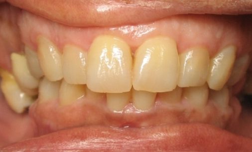 before1 Abari Orthodontics and Oral Surgery - before & after