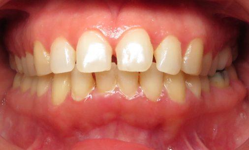 before12 Abari Orthodontics and Oral Surgery - before & after