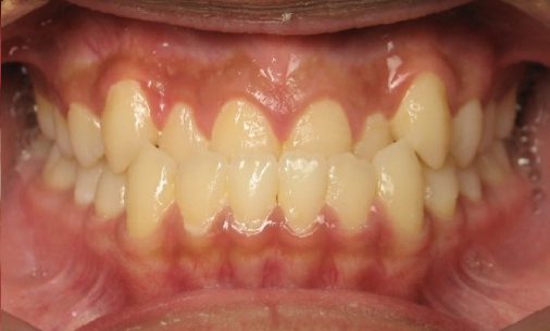 before2 Abari Orthodontics and Oral Surgery - before & after