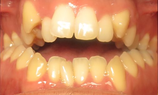 before7 Abari Orthodontics and Oral Surgery - before & after