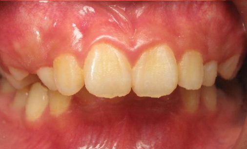 before8 Abari Orthodontics and Oral Surgery - before & after