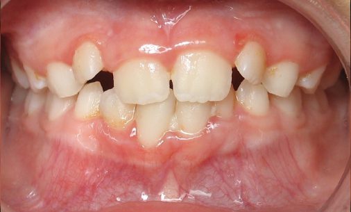 before5 1 Abari Orthodontics and Oral Surgery - before & after