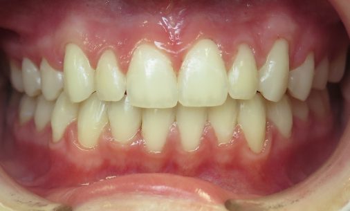 before5 2 Abari Orthodontics and Oral Surgery - before & after