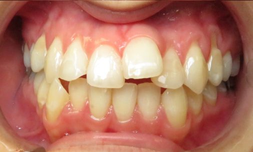 before5 3 Abari Orthodontics and Oral Surgery - before & after
