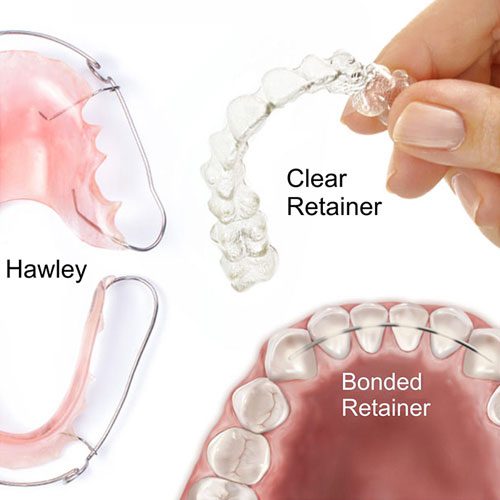 types retainers. pic 1 Abari Orthodontics and Oral Surgery - retainers